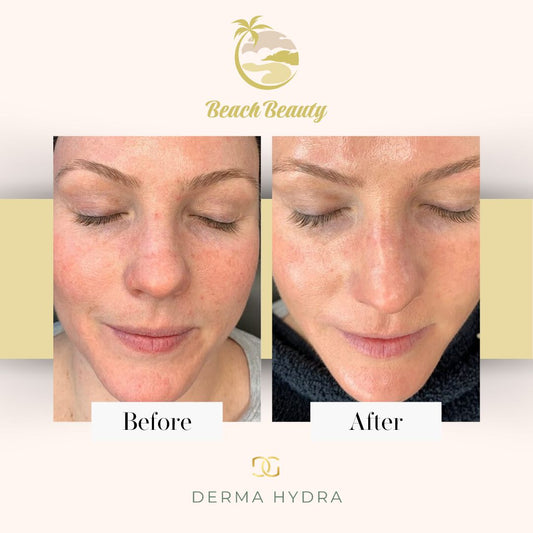 Hydra Derma Facial Before & After